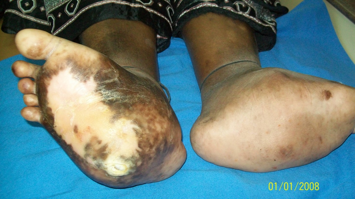 Charcots Foot