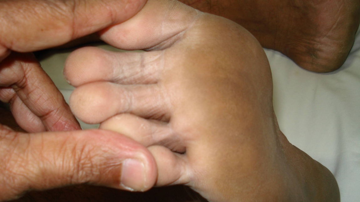 Diabetic Neuropathy