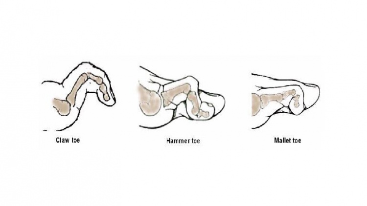 FOOT DEFORMITIES IN DIABETES