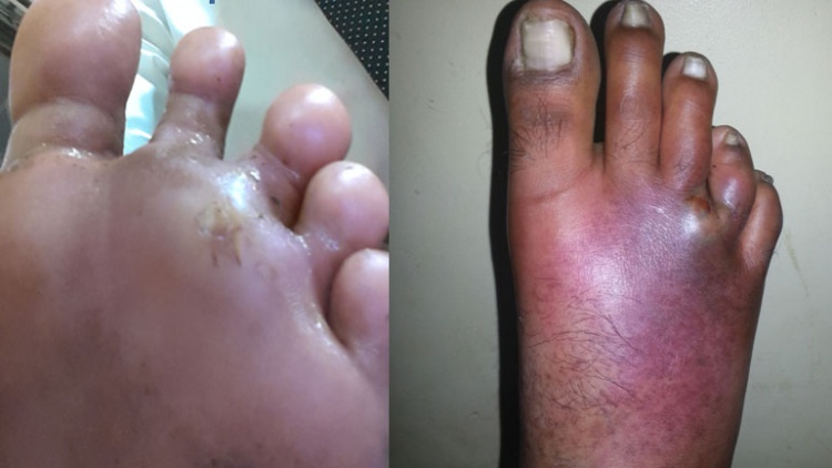 ABSCESS IN THE FOOT